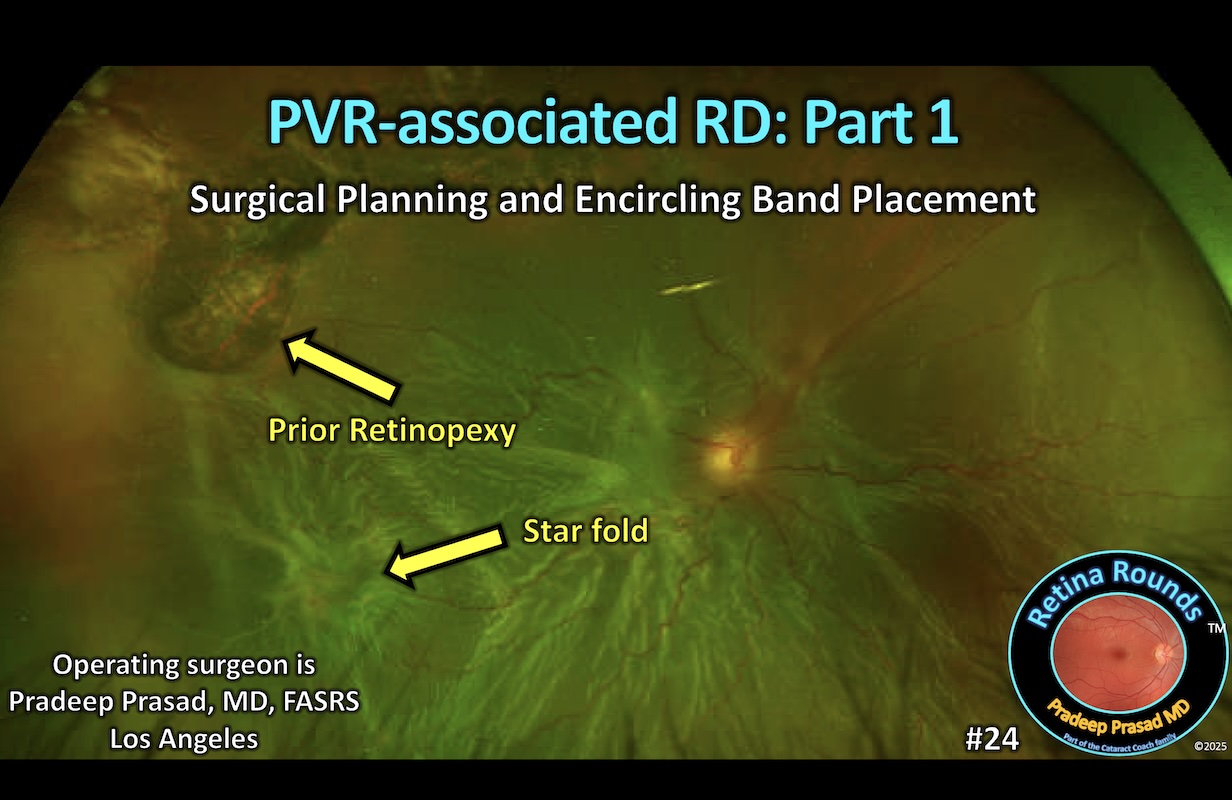 PVR associated retinal detachment
