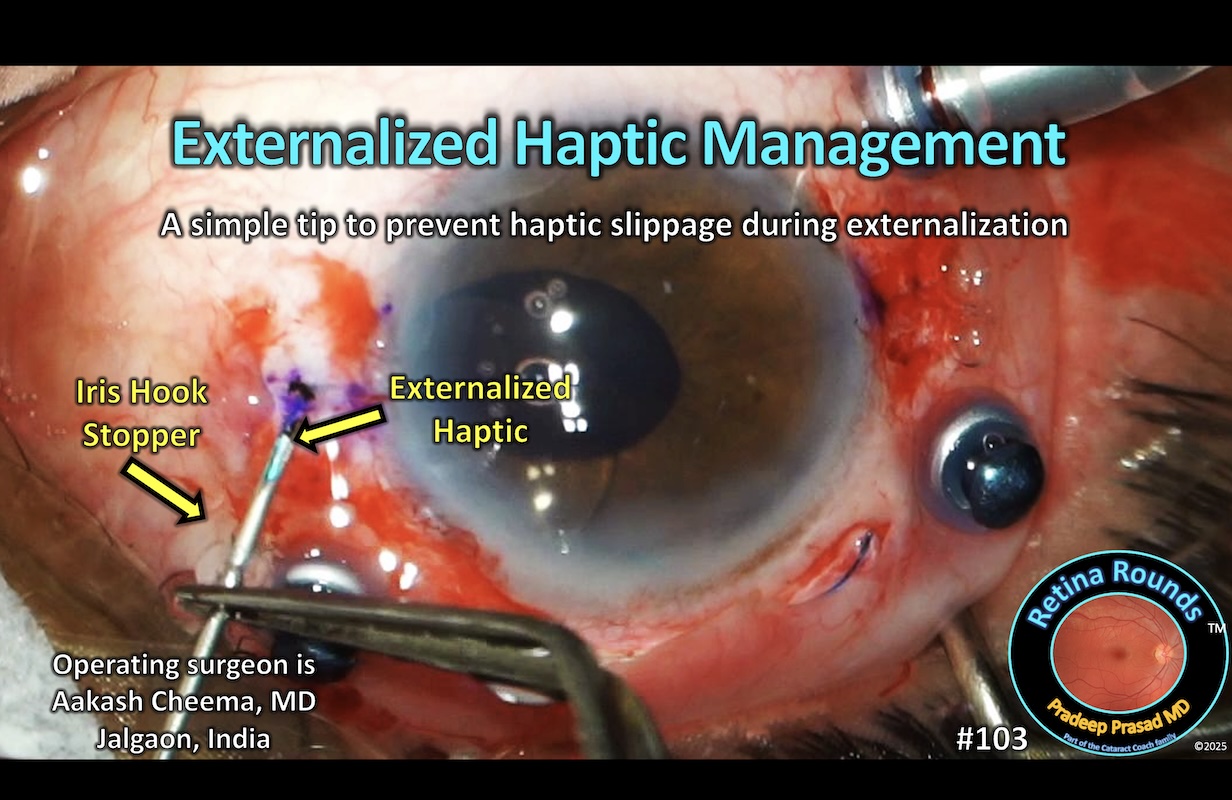 Externalized haptic management when implanting a scleral-fixated IOL.