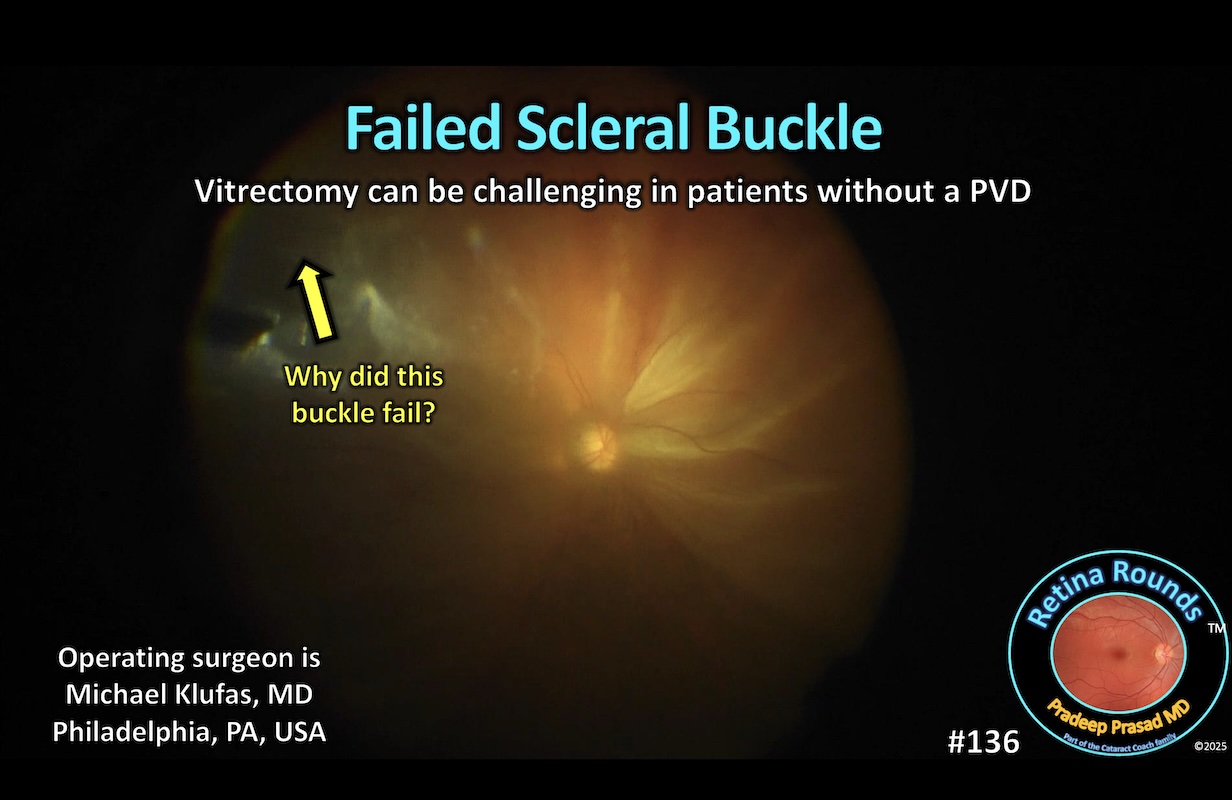 Management of a failed scleral buckle