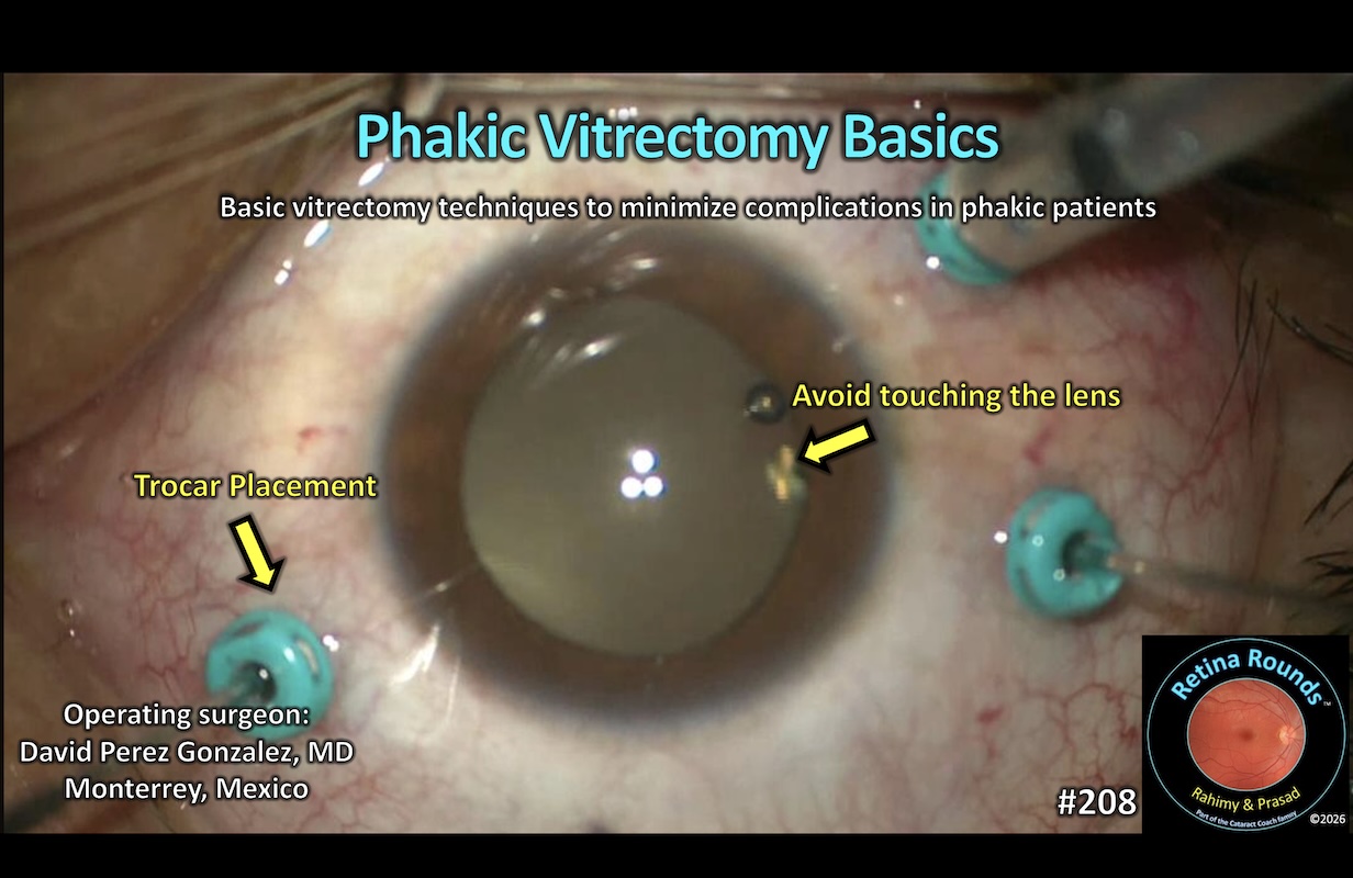 Phakic Vitrectomy Basics