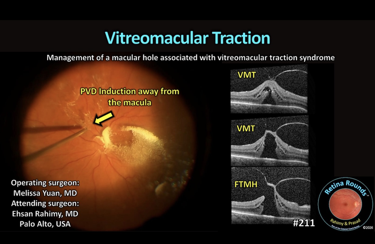 vitreomacular-traction