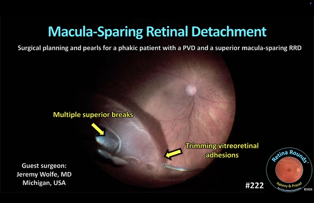 Macula-Sparing Retinal Detachment